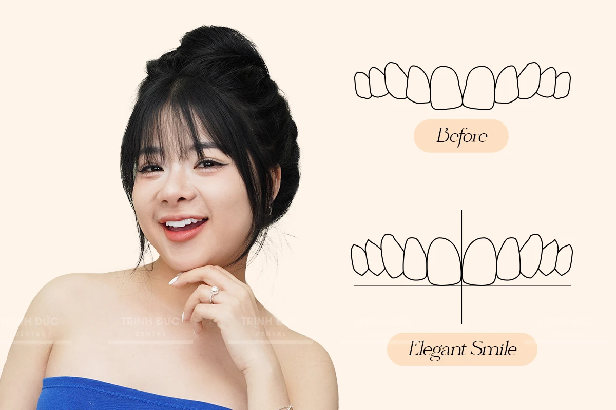 Phần mềm thiết kế nụ cười Elegant Smile