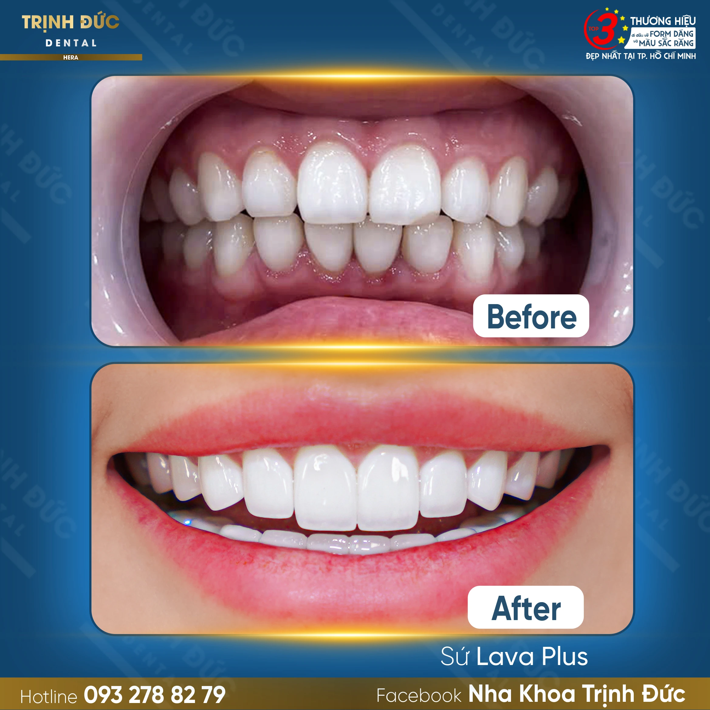 Làm răng tại Việt Nam: Điểm đến lý tưởng cho nụ cười đẳng cấp thế giới