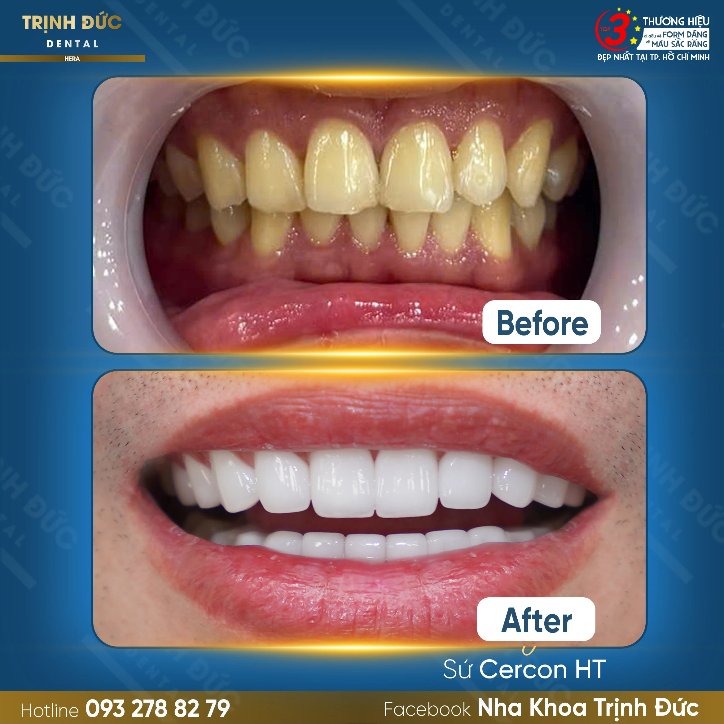 Răng sứ cho nam giới