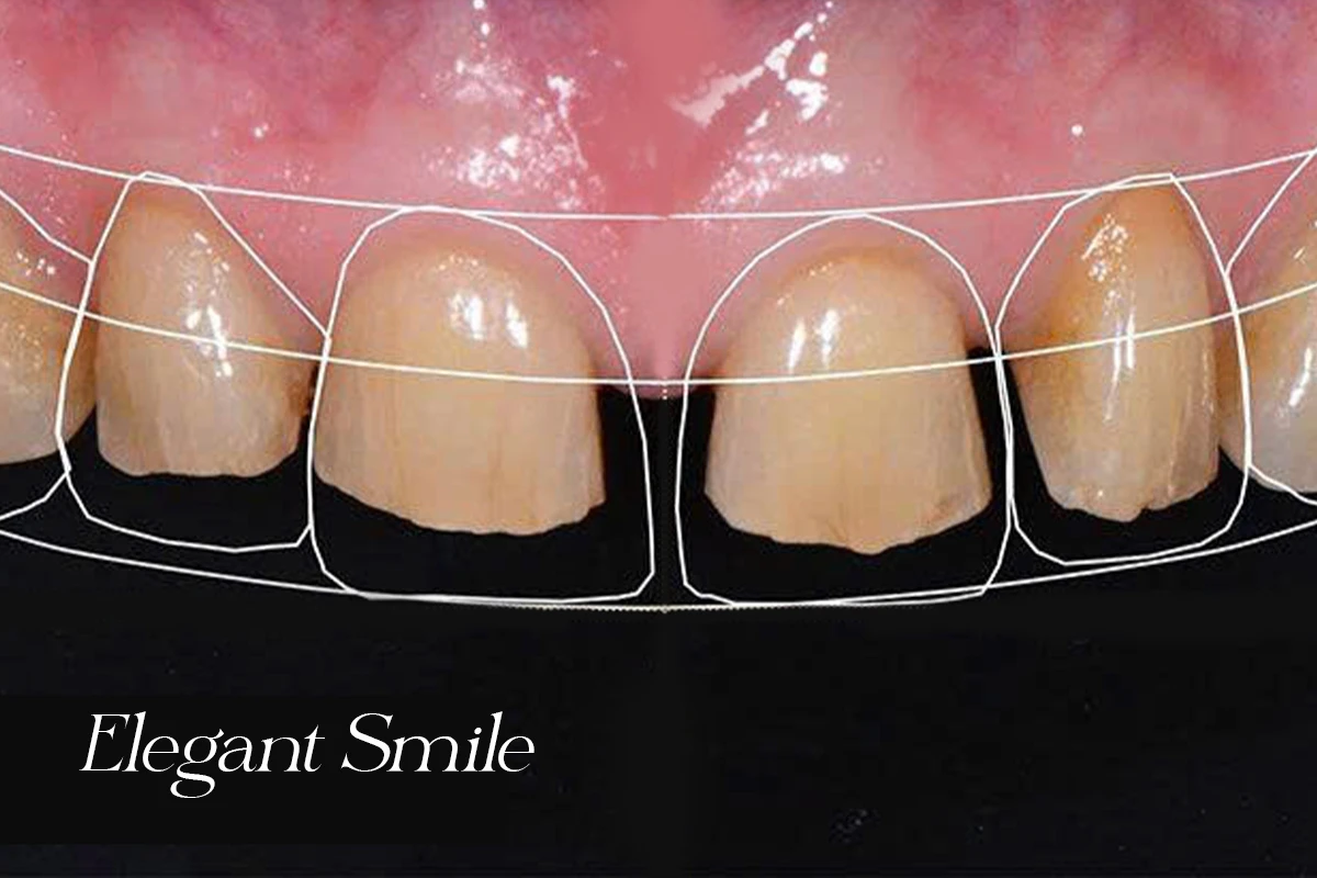 Phần mềm thiết kế nụ cười Elegant Smile