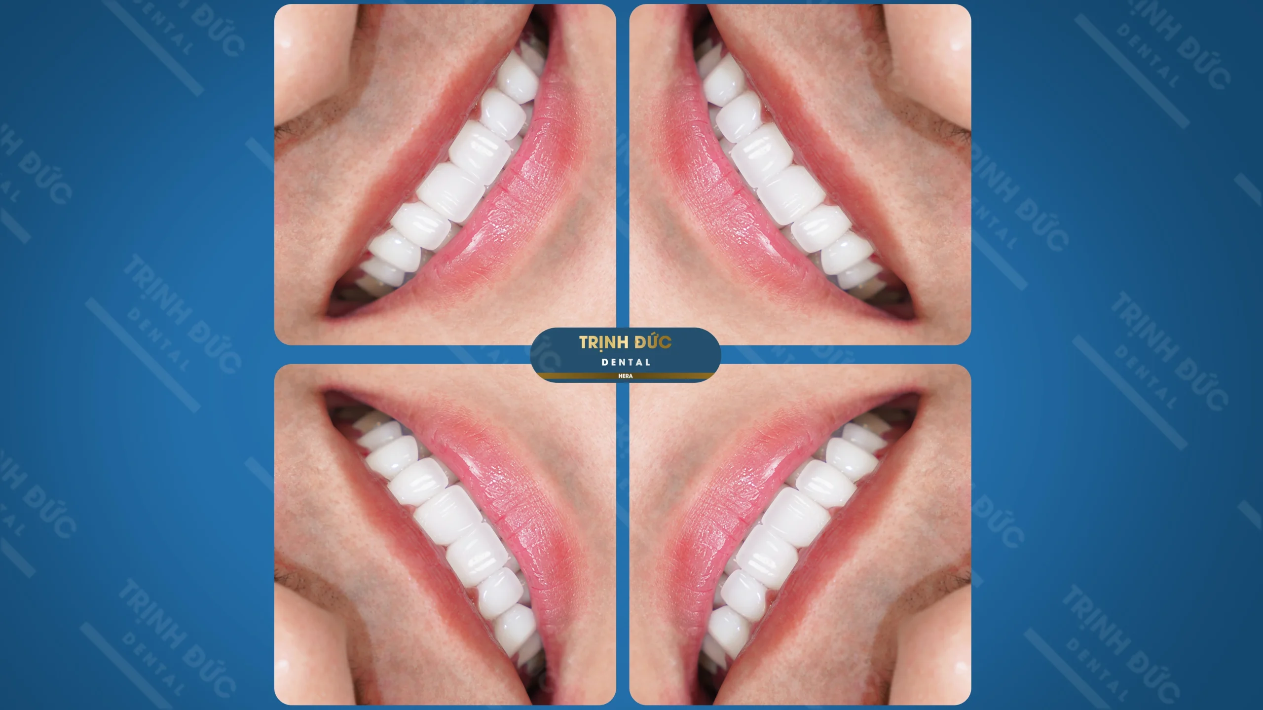 Răng sứ cho nam giới