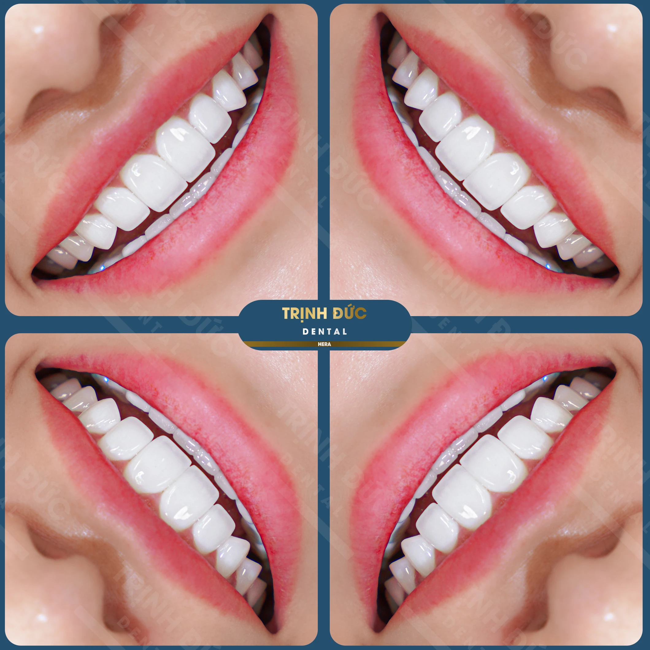 Làm răng tại Việt Nam: Điểm đến lý tưởng cho nụ cười đẳng cấp thế giới