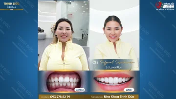 Làm răng tại Việt Nam: Điểm đến lý tưởng cho nụ cười đẳng cấp thế giới