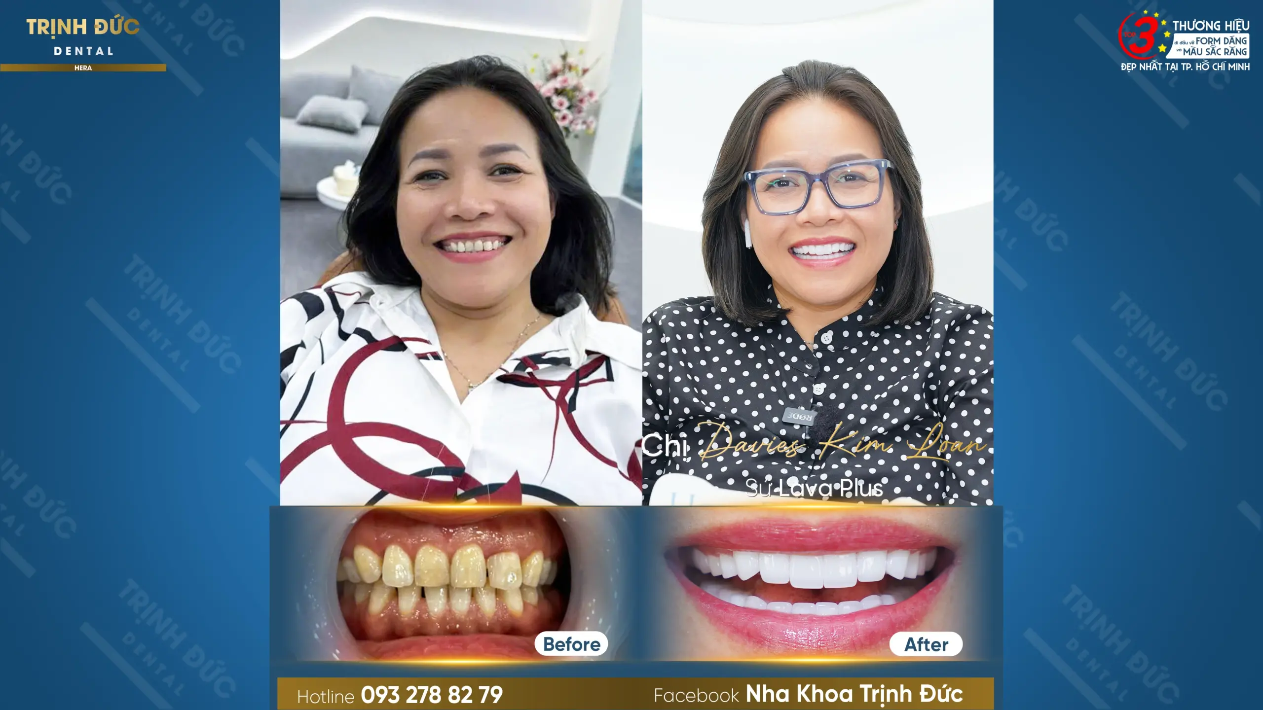 Hình ảnh trước và sau khi làm răng sứ thẩm mỹ của chị Kim Loan