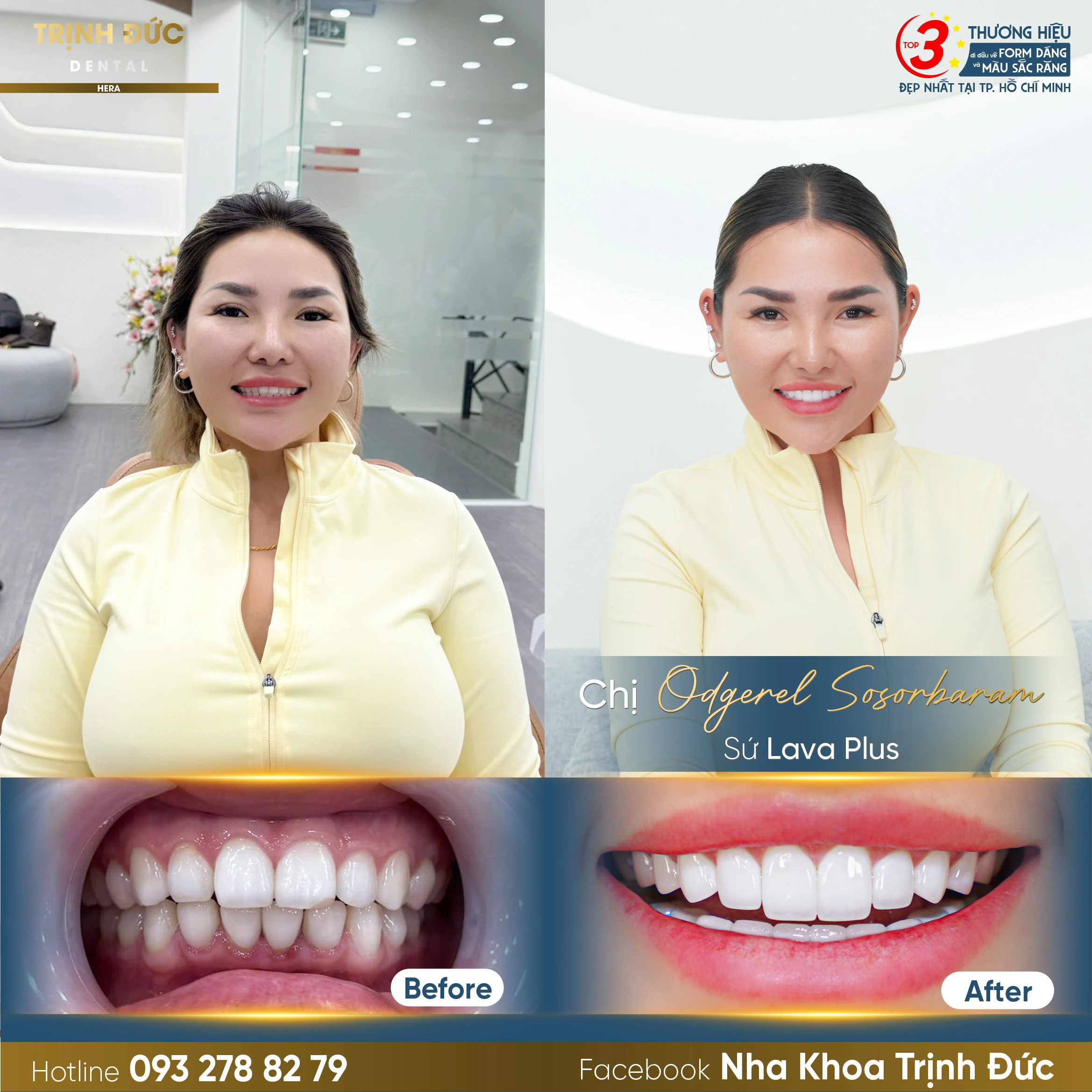 Làm răng tại Việt Nam: Điểm đến lý tưởng cho nụ cười đẳng cấp thế giới