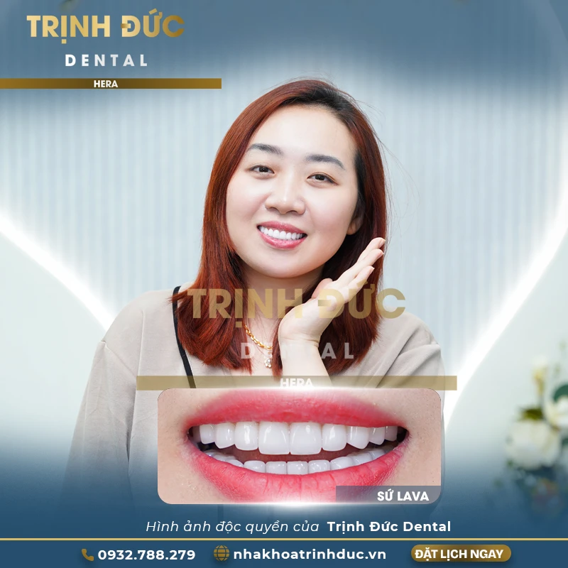 Review kết quả bọc toàn sứ KH Hana Cẩm Tiên do răng cụp, mòn mặt ăn nhai, nhiễm màu, ố vàng (nhân bản)