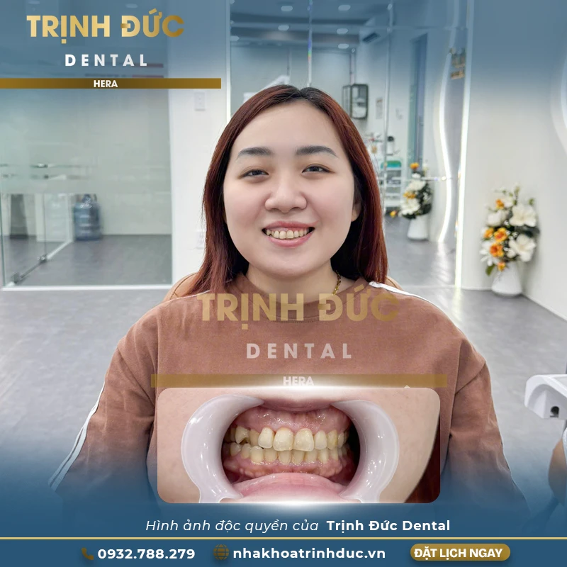 Review kết quả bọc toàn sứ KH Hana Cẩm Tiên do răng cụp, mòn mặt ăn nhai, nhiễm màu, ố vàng (nhân bản)