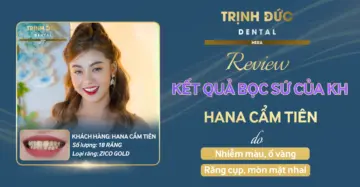 Review kết quả bọc toàn sứ KH Hana Cẩm Tiên do răng cụp, mòn mặt ăn nhai, nhiễm màu, ố vàng (nhân bản)