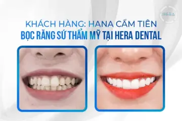 Review kết quả bọc toàn sứ KH Hana Cẩm Tiên do răng cụp, mòn mặt ăn nhai, nhiễm màu, ố vàng