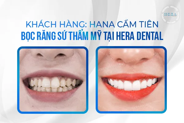 Review kết quả bọc toàn sứ KH Hana Cẩm Tiên do răng cụp, mòn mặt ăn nhai, nhiễm màu, ố vàng